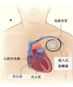 ICDֲʾD